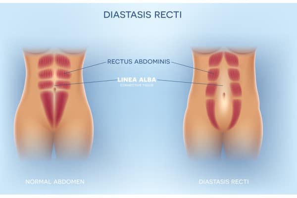 What Non-Surgical Options Are Available for Diastasis Recti Bradford on Avon?