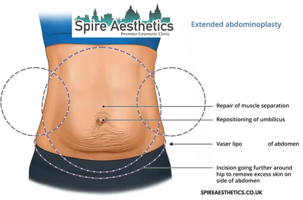 Understanding Loose Skin After Gastric Band Bradford on Avon Surgery and HIFU Treatment 