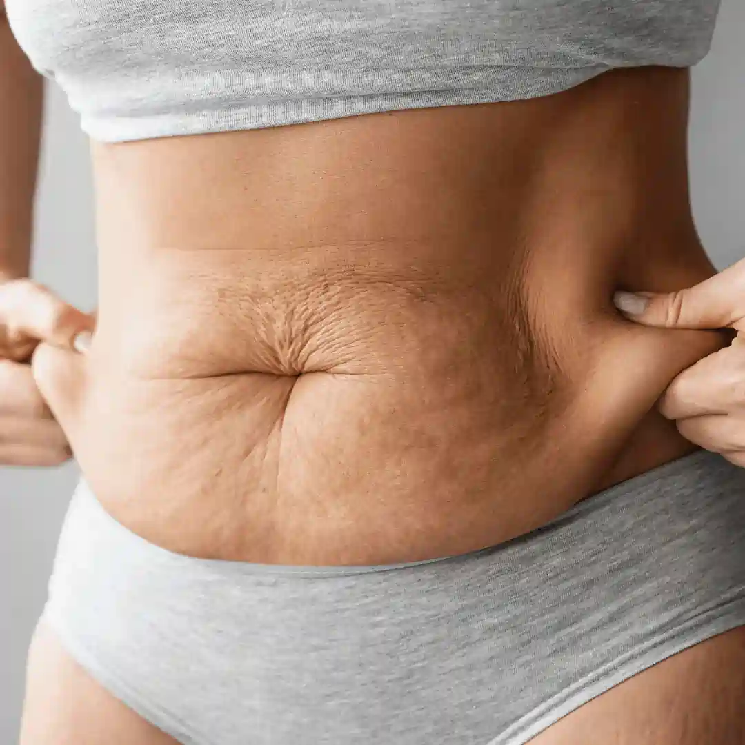 Is It Normal to Have Loose Skin After Pregnancy Bradford on Avon?