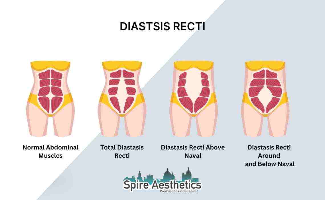Is Non-Surgical Diastasis Recti Treatment Right for You? Common Concerns Answered Bradford on Avon